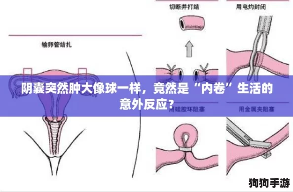 阴囊突然肿大像球一样，竟然是“内卷”生活的意外反应？