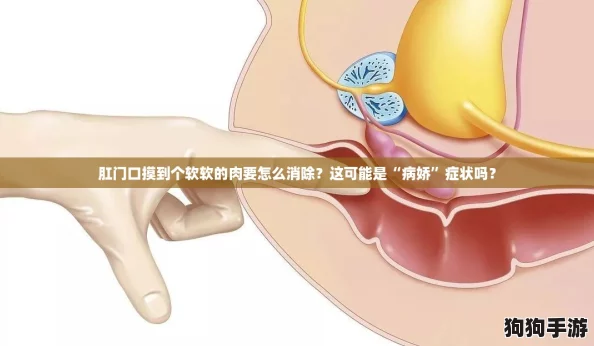 肛门口摸到个软软的肉要怎么消除?这可能是“病娇”症状吗? 肛门口摸到个软软的肉要怎么消除?这可能是“病娇”症状吗?