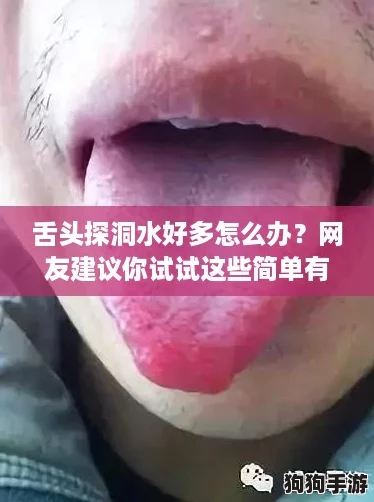 舌头探洞水好多怎么办?网友建议你试试这些简单有效的缓解方法! 舌头探洞水好多怎么办?网友建议你试试这些简单有效的缓解方法!