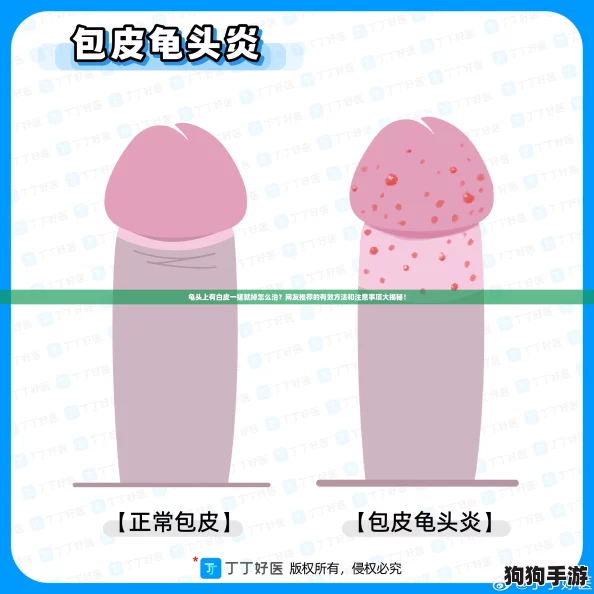 龟头上有白皮一搓就掉怎么治？网友推荐的有效方法和注意事项大揭秘！