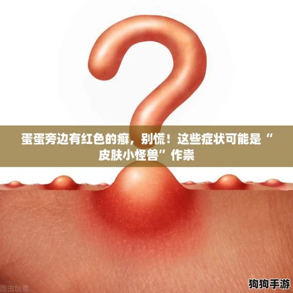 蛋蛋旁边有红色的癣,别慌!这些症状可能是“皮肤小怪兽”作祟 蛋蛋旁边有红色的癣,别慌!这些症状可能是“皮肤小怪兽”作祟